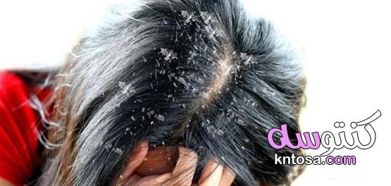 قشرة الشعر،أسباب ظهور القشرة في الشّعر ،كيفية معالجة قشرة الشعر ، وصفات طبيعية لعلاج لقشرة الشعر kntosa.com_05_19_156