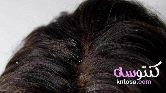 قشرة الشعر،أسباب ظهور القشرة في الشّعر ،كيفية معالجة قشرة الشعر ، وصفات طبيعية لعلاج لقشرة الشعر kntosa.com_05_19_156
