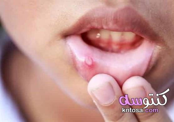 قرحة الفم الأسباب وطرق العلاج kntosa.com_06_19_157