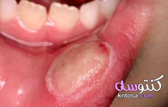 قرحة الفم الأسباب وطرق العلاج kntosa.com_06_19_157