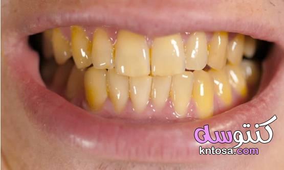 ما سبب اصفرار الأسنان وكيفية الوقاية لأسنان ناصعة البياض