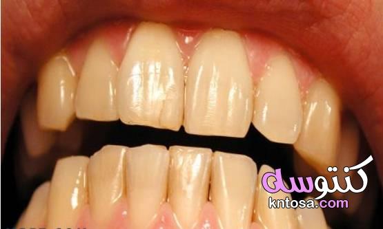ما سبب اصفرار الأسنان وكيفية الوقاية لأسنان ناصعة البياض
