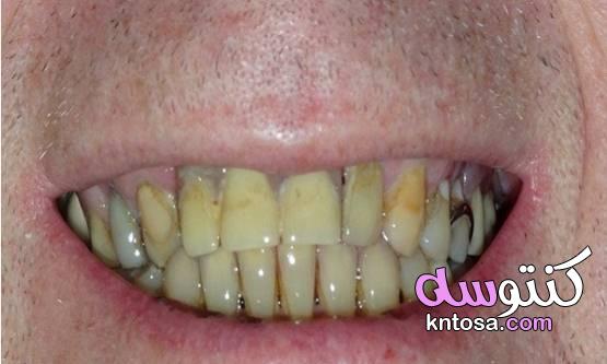 ما سبب اصفرار الأسنان وكيفية الوقاية لأسنان ناصعة البياض kntosa.com_06_21_161