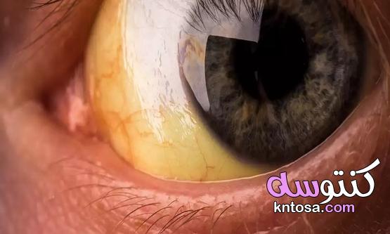 اليرقان معلومات مذهلة عن مرض إصفرار العين 2020 kntosa.com_09_20_159