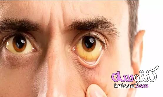 اليرقان معلومات مذهلة عن مرض إصفرار العين 2020 kntosa.com_09_20_159