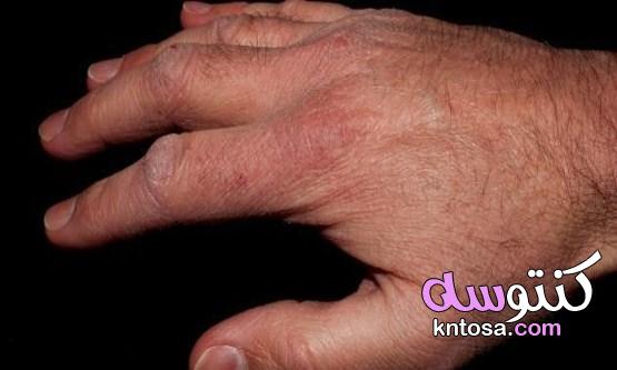 ما سبب تقشر الجلد وكيفية العلاج نهائيًا بالأعشاب kntosa.com_09_21_162