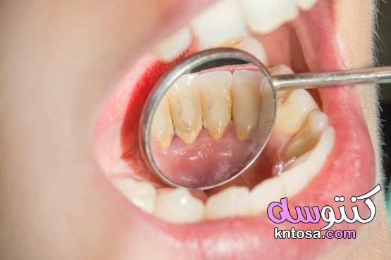كيف تتخلص من صفار الأسنان نهائيًا بوصفات منزلية سهلة وبسيطة kntosa.com_09_21_162