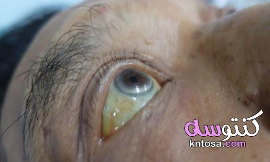 علاج اصفرار العين الغير مرضى | اهم الاسباب وافضل طرق العلاج kntosa.com_09_21_163