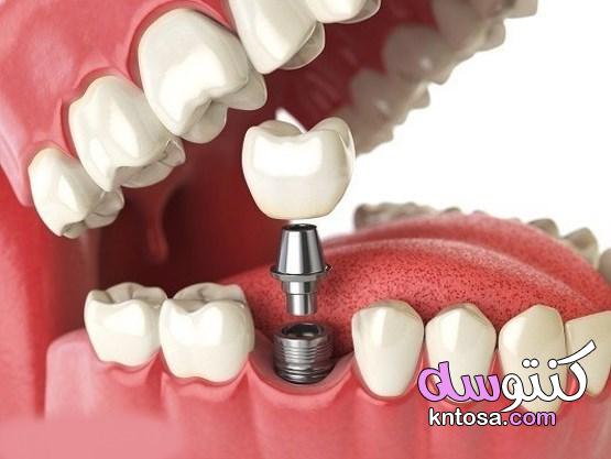 ما هي مدة زراعة الاسنان kntosa.com_09_22_164