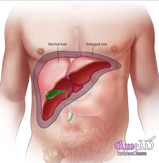 اعراض تليف الكبد ، اسباب تليف الكبد ، علاج أسباب تليف الكبد 2020 kntosa.com_10_19_156