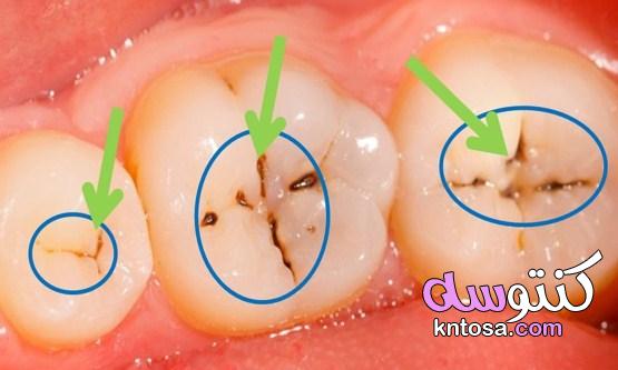 إزالة تسوس الاسنان| 11 طريقة للتخلص من التسوس نهائيا kntosa.com_10_21_161