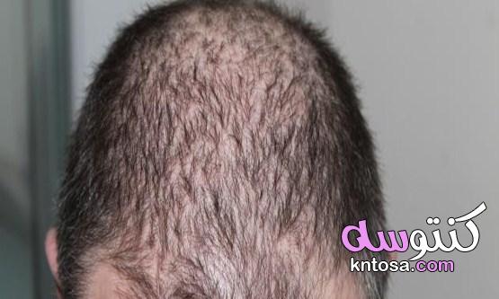اسباب تساقط الشعر من الجذور عند الرجال والنساء kntosa.com_10_21_161