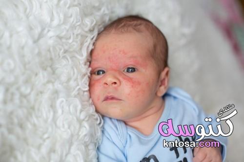 كيف أفتح بشرة طفلي .7 مشاكل شائعة لدى بشرة الأطفال kntosa.com_12_19_155