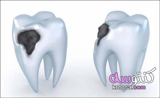أسباب تسوس الأسنان عند الكبار وطرق العلاج بالملح والقرنفل kntosa.com_12_21_161