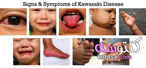 اسباب وأعراض فيروس كوكساكي وطرق علاجه kntosa.com_13_21_162