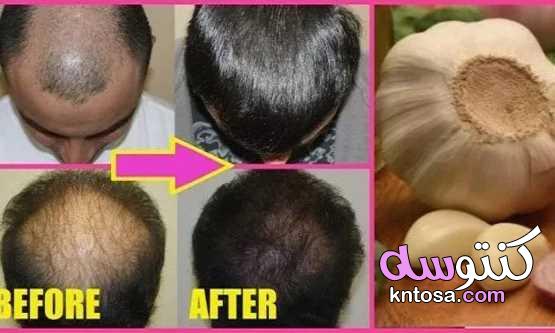 علاج تساقط الشعر في المنزل بمواد طبيعية القوم لتساقط الشعر 2020 kntosa.com_15_20_157