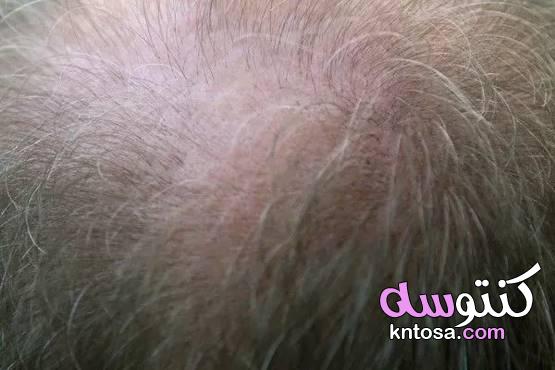 4 فيتامينات تمنع تساقط الشعر مشاكل الشعر 2020 kntosa.com_18_19_157