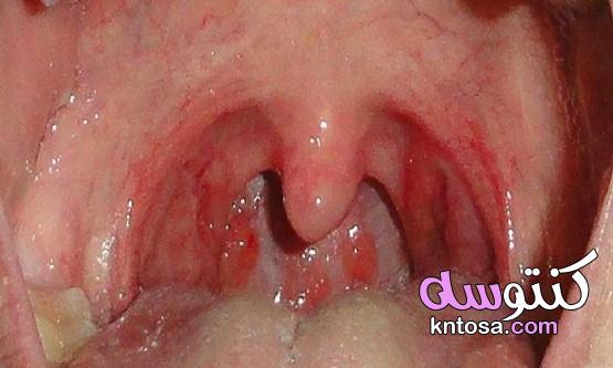 أسباب التهاب بكتيري في الحلق وطرق العلاج طبيعيًا وطبيًا kntosa.com_18_21_161