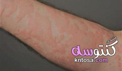 اسباب حساسية الجلد وأبرز أعراضها kntosa.com_19_19_155