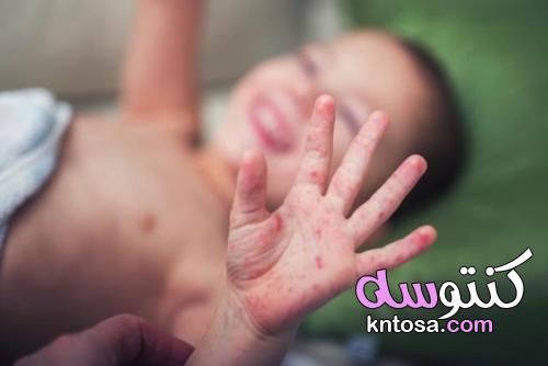 مرض اليد والقدم والفم يهدد الأطفال!