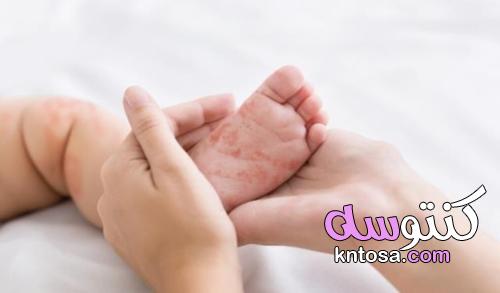 مرض اليد والقدم والفم يهدد الأطفال! kntosa.com_21_21_162