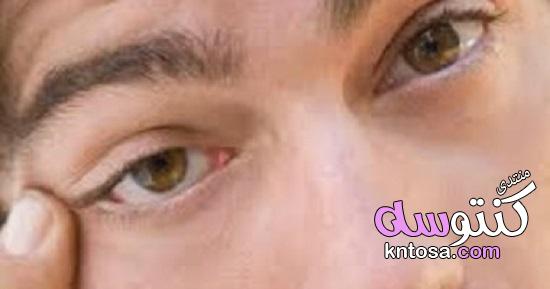 علاج جفاف العين,تخلص من جفاف عينيك بدون طبيب,أعراض جفاف العين ونصائح لعلاجه kntosa.com_22_19_155