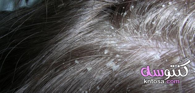 طرق طبيعيه للتخلص من قشره الشعر,وصفة للتخلص من القشر,علاج القشرة بالطرق الطبيعية في المنزل kntosa.com_22_19_155