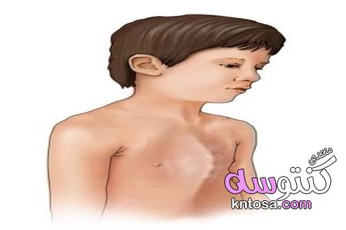 ما هو الصدر الجؤجؤي عند الاطفال، علاج الصدر الجؤجؤي، مواصفات الصدر الجؤجؤي kntosa.com_22_19_155