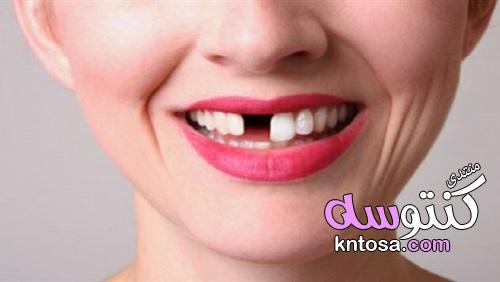 أهم طرق علاج الأسنان المفقودة kntosa.com_23_19_155