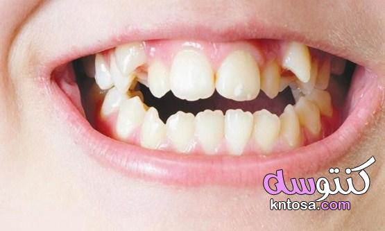 كيف يعمل تقويم الأسنان وطريقه تركيبه الصحيحة وأنواعه kntosa.com_26_21_161