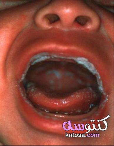 أسباب الإصابة بفطريات الفم -Thrush- عند حديثي الولادة kntosa.com_26_21_163