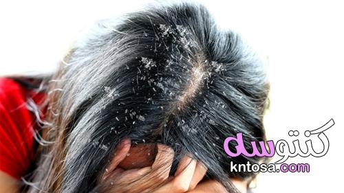 "علاج سحري".. وصفات علاج قشره الشعر من أول مرة استخدام لاحظي الفرق ونصائح لمنع ظهورها kntosa.com_28_22_164