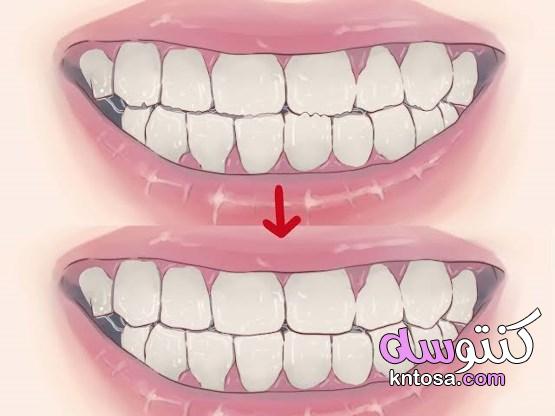صرير الأسنان.. أضرار متنوعة وعلاجات مساعدة 2020 kntosa.com_29_19_157