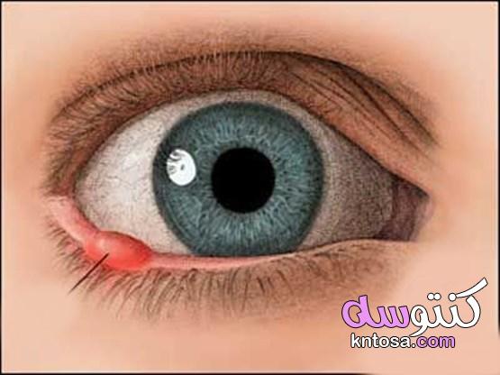 دمل العين.. الأسباب والأعراض وطرق العلاج 2020 kntosa.com_30_19_157