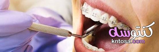 تقويم الأسنان، دواعي استعمال تقويم الأسنان طرق تقويم الأسنان ،كيف نتعامل مع تقويم الاسنان المؤلم kntosa.com_31_19_156