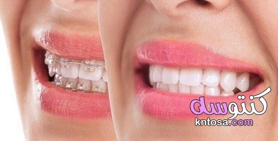 تقويم الأسنان، دواعي استعمال تقويم الأسنان طرق تقويم الأسنان ،كيف نتعامل مع تقويم الاسنان المؤلم kntosa.com_31_19_156